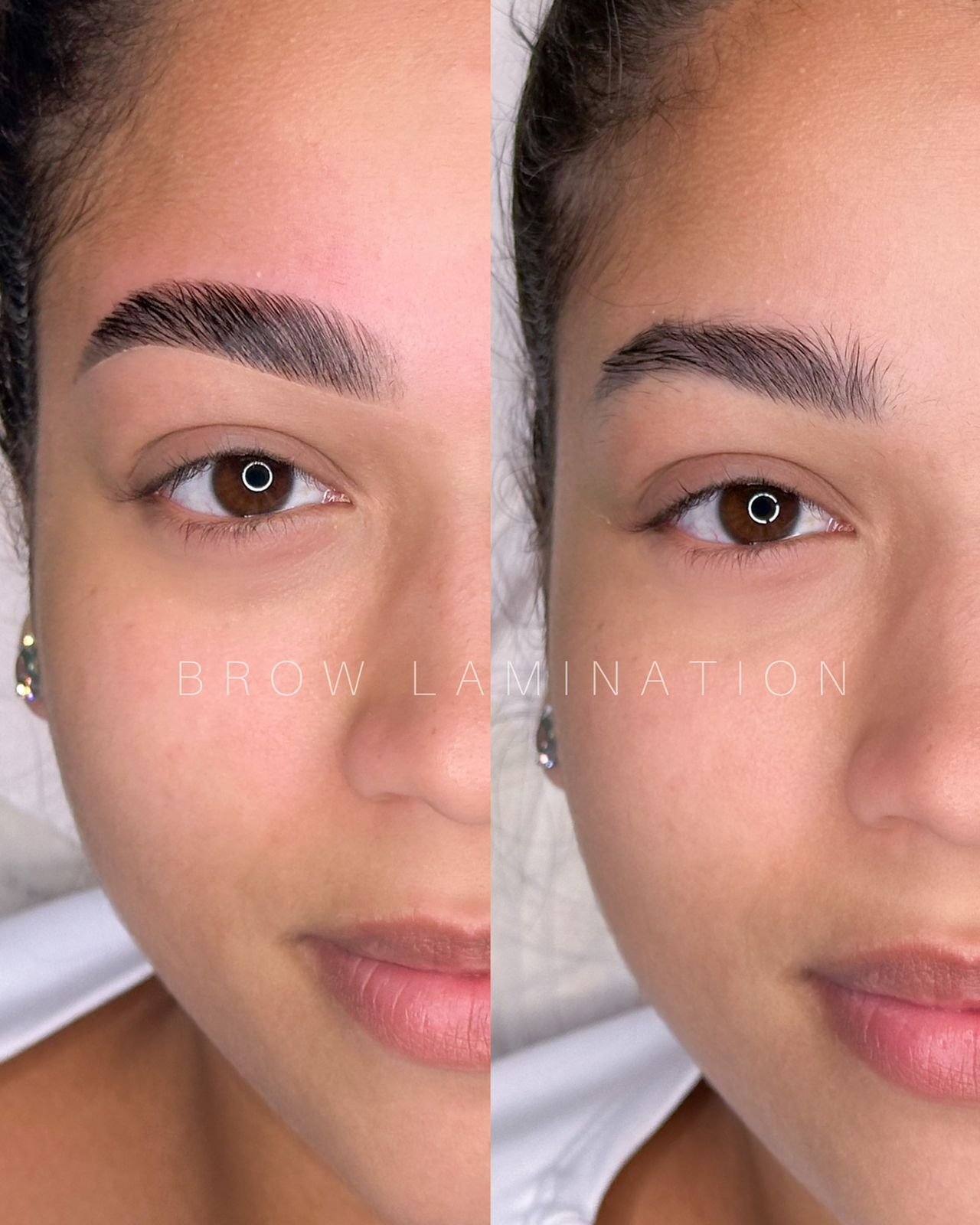 Resultado real de procedimento CM Beauty 2