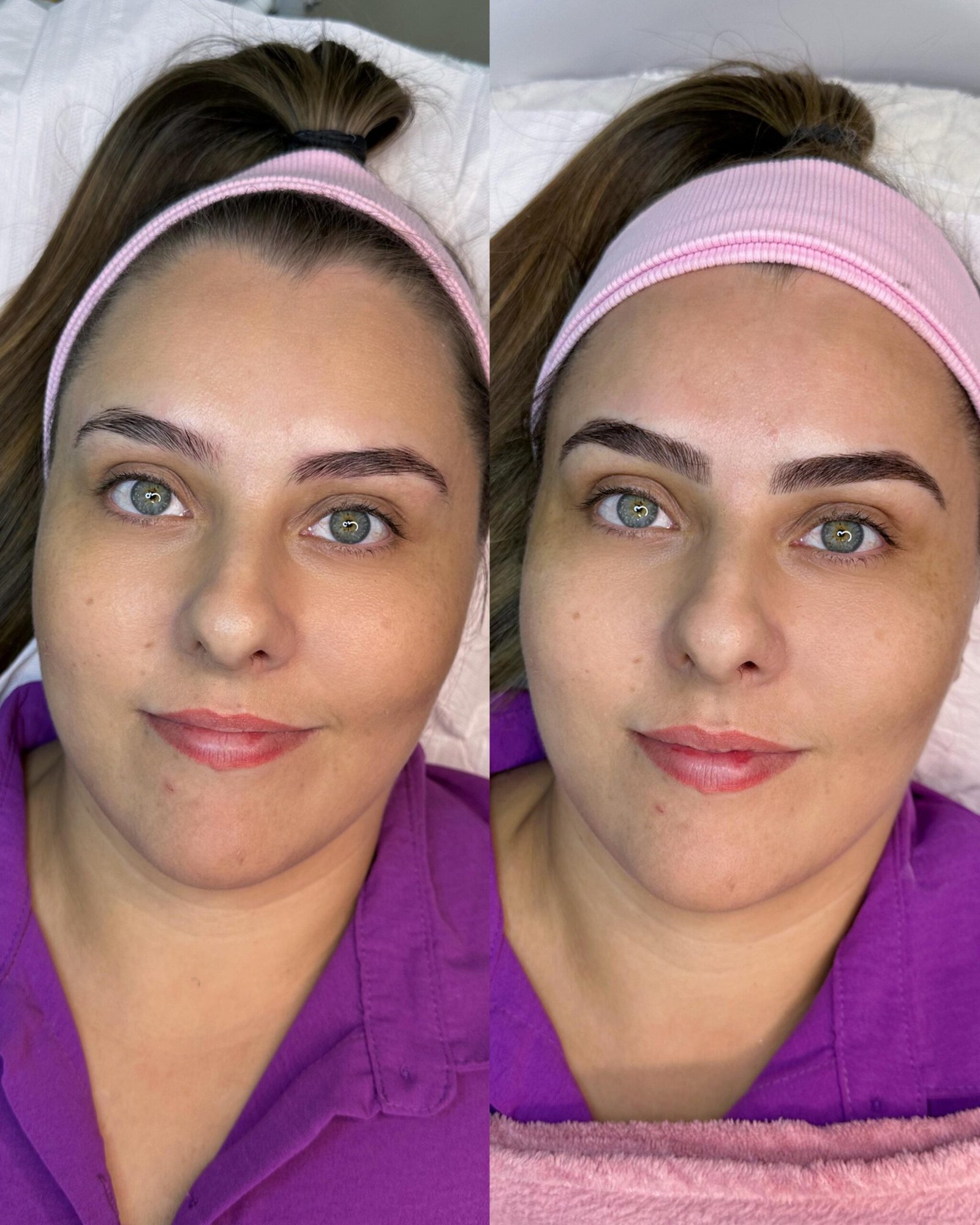 Resultado real de procedimento CM Beauty 3