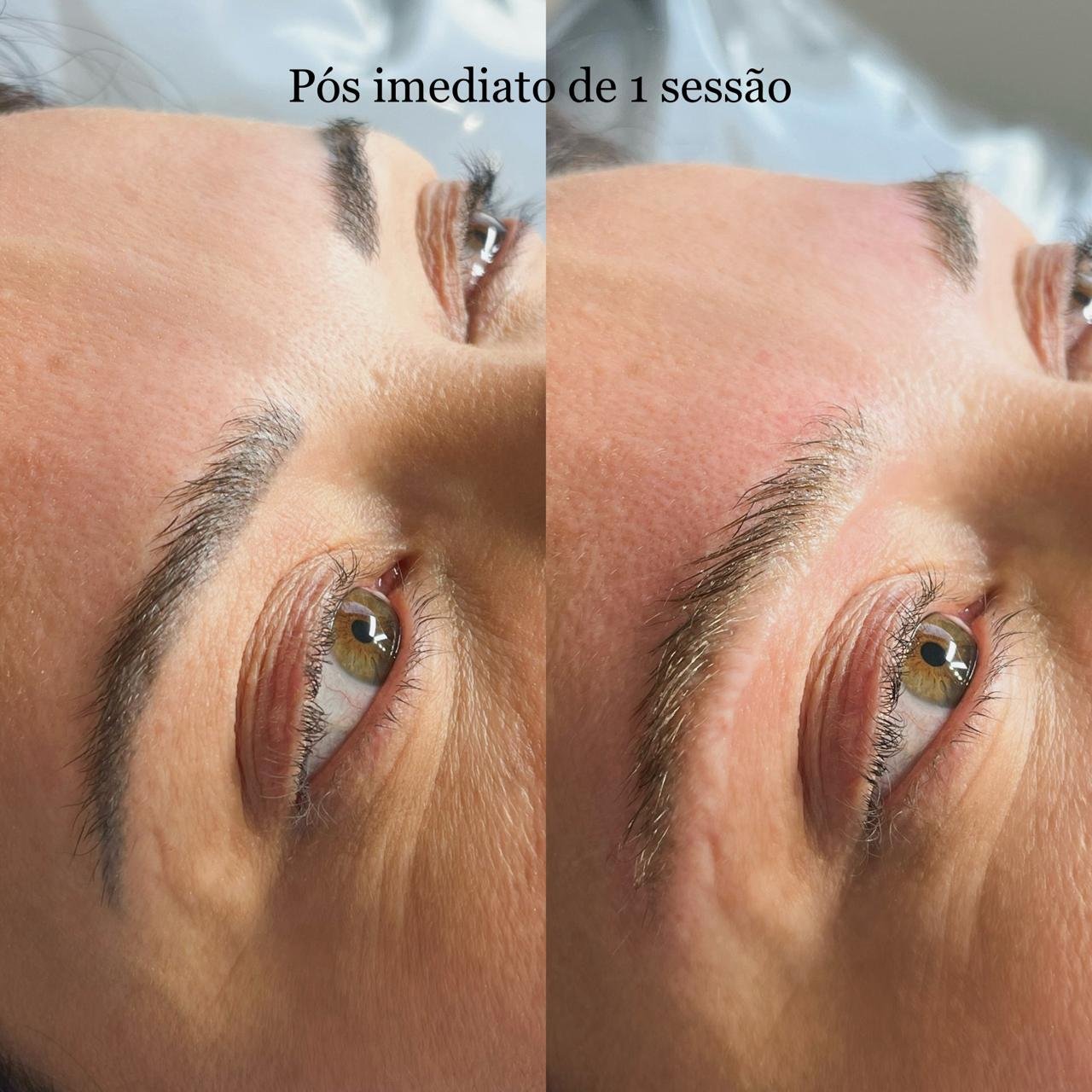 Resultado real de procedimento CM Beauty 4